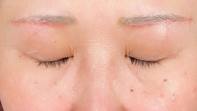 Postoperative Condition Part 1