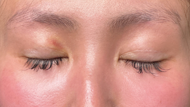 Postoperative Condition Part 1