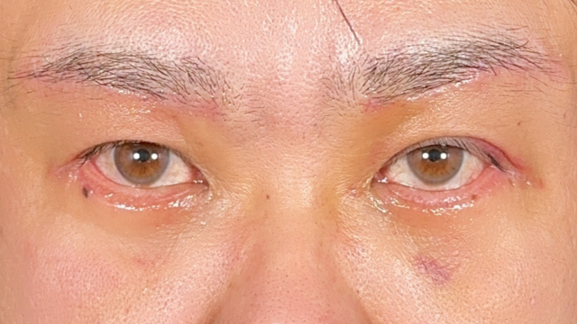 Postoperative Condition Part 1