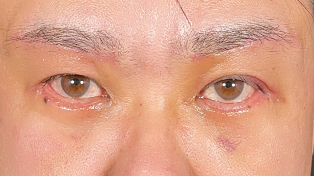 Postoperative Condition Part 1