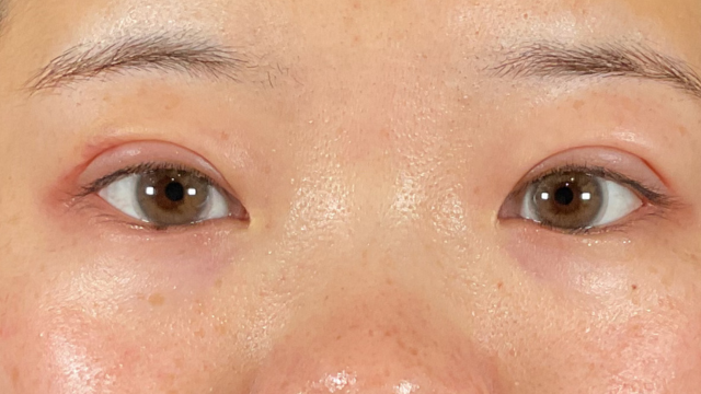 Postoperative Condition Part 1