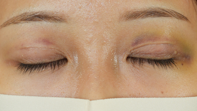 Postoperative Condition Part 1