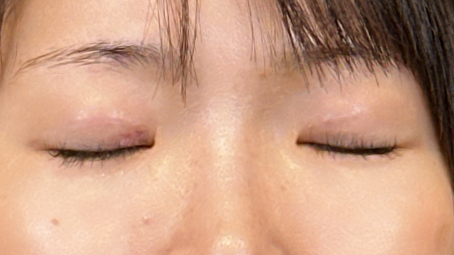 Postoperative Condition Part 1