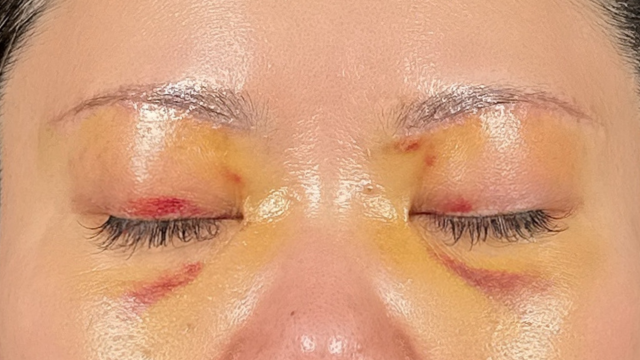 Postoperative Condition Part 1