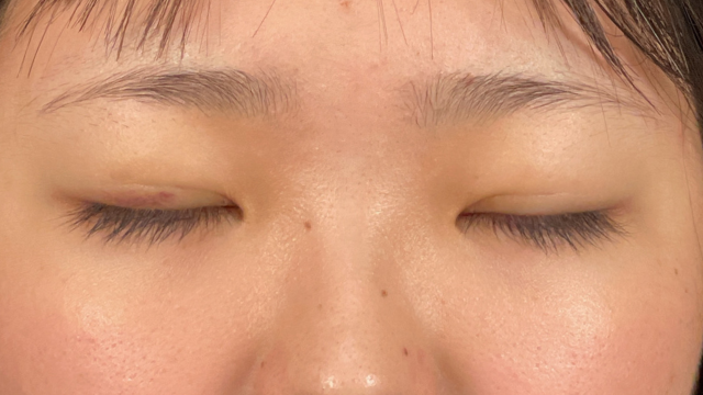 Postoperative Condition Part 1