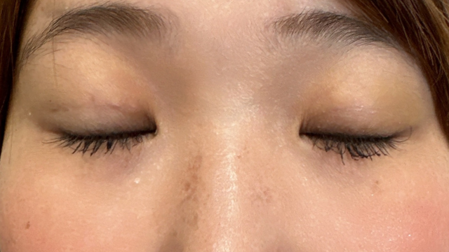 Postoperative Condition Part 1