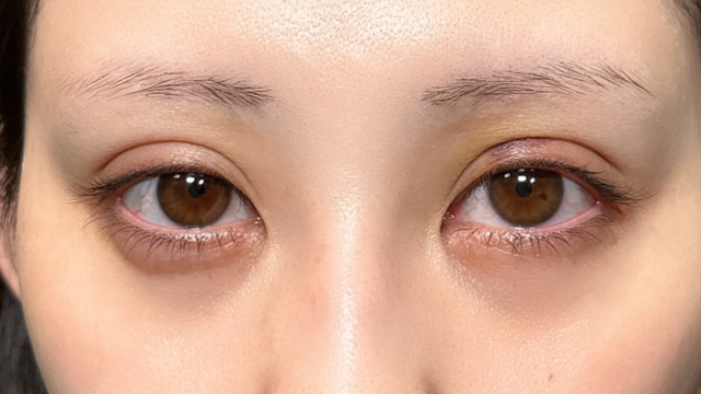 Postoperative Condition Part 1