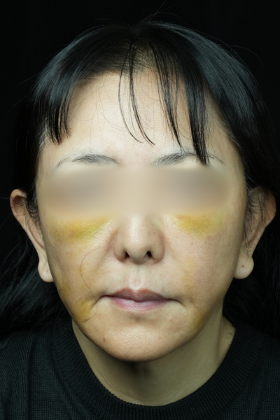 手術前の状態 その1