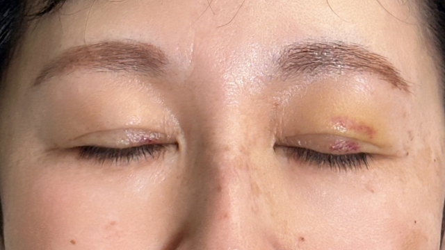 Postoperative Condition Part 1