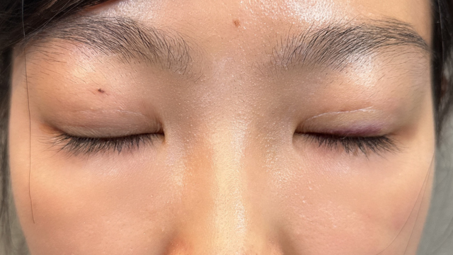 Postoperative Condition Part 1