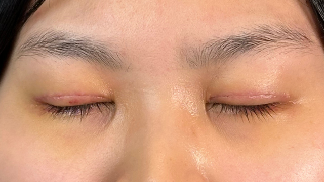 Postoperative Condition Part 1