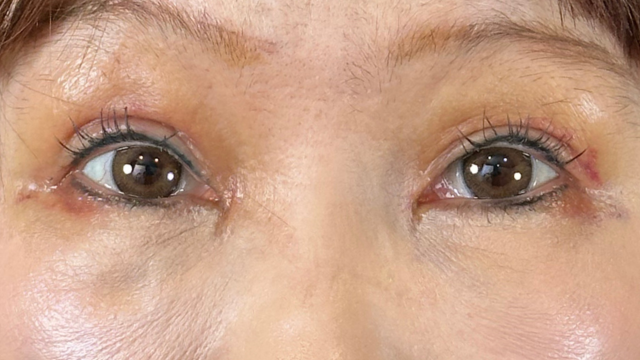 Postoperative Condition Part 1