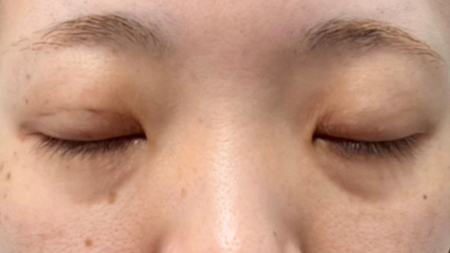 Postoperative Condition Part 1