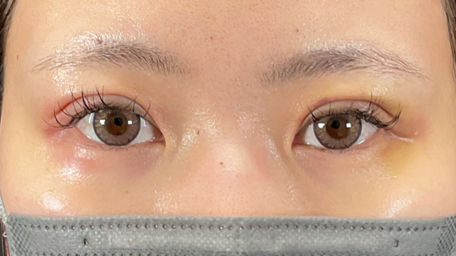 Postoperative Condition Part 1