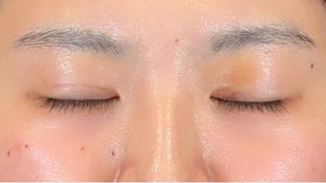 Postoperative Condition Part 1