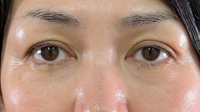 Postoperative Condition Part 1