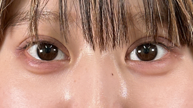 手術前の状態 その1