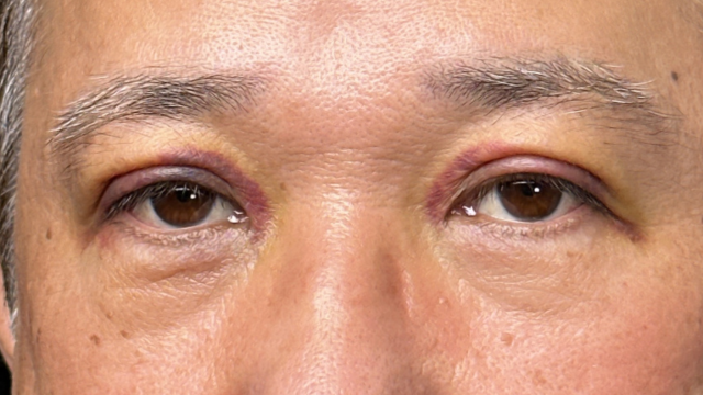 Postoperative Condition Part 1