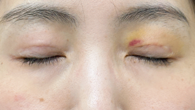 Postoperative Condition Part 1