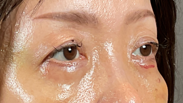 Postoperative Condition Part 1