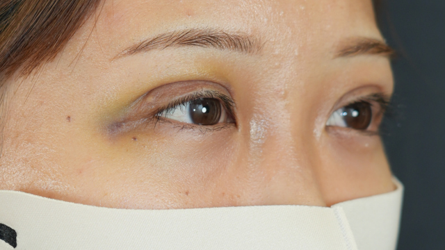 Postoperative Condition Part 1