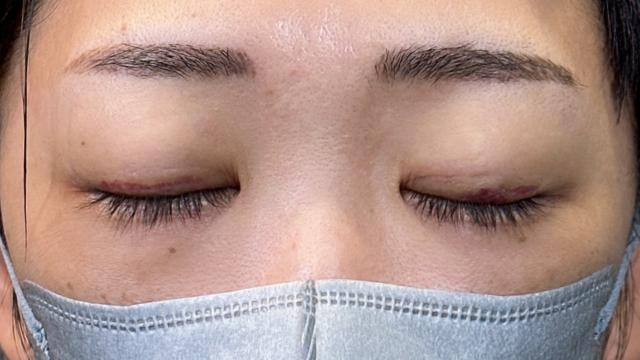 Postoperative Condition Part 1