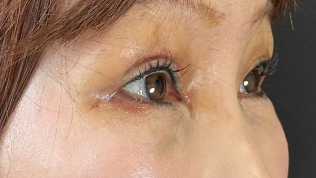 Postoperative Condition Part 1