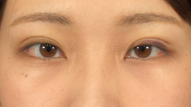 Postoperative Condition Part 1