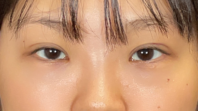 Postoperative Condition Part 1