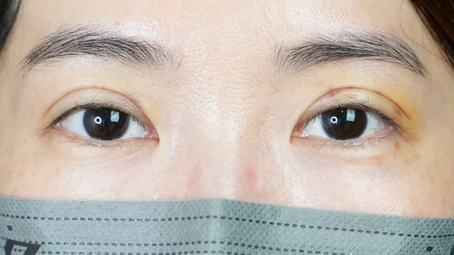 Postoperative Condition Part 1