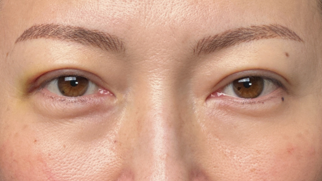 Postoperative Condition Part 1