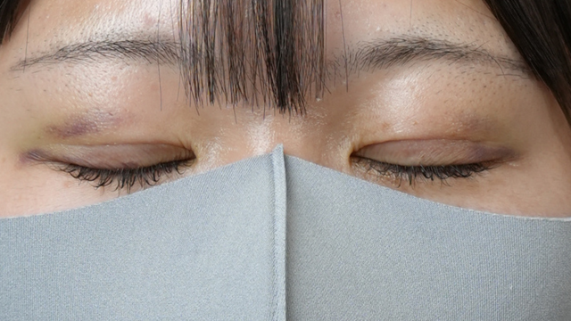 Postoperative Condition Part 1