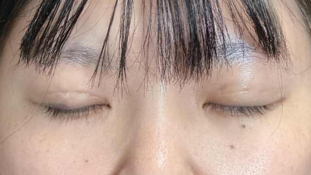 Postoperative Condition Part 1