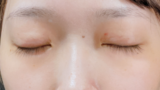 Postoperative Condition Part 1