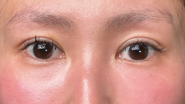 Postoperative Condition Part 1