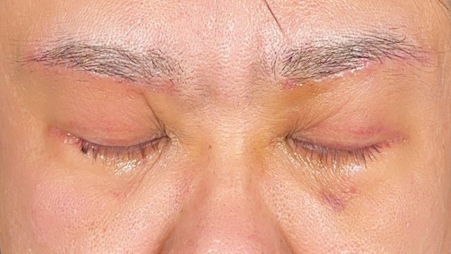 Postoperative Condition Part 1