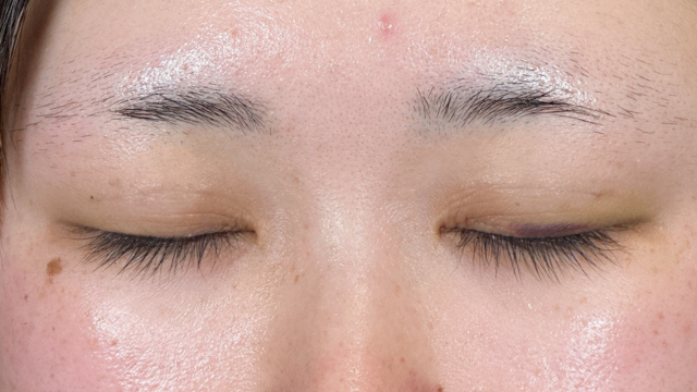 Postoperative Condition Part 1