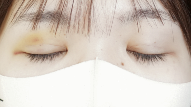 Postoperative Condition Part 1