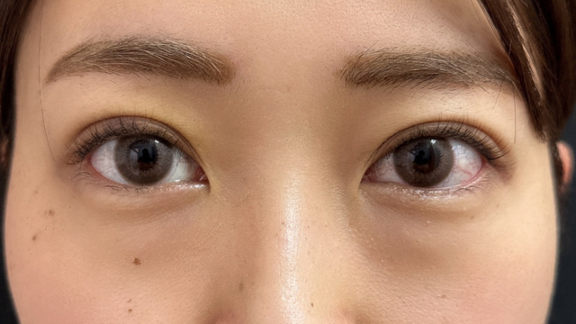 Postoperative Condition Part 1