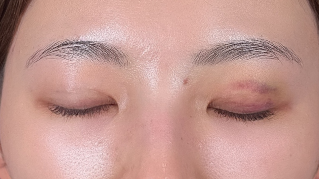 Postoperative Condition Part 1