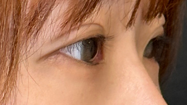 手术前的状态 其一