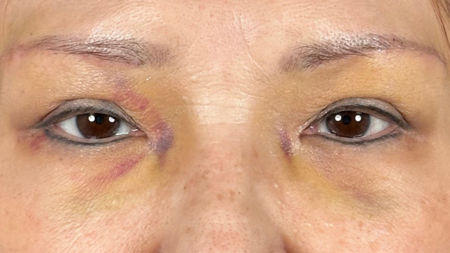 Postoperative Condition Part 1