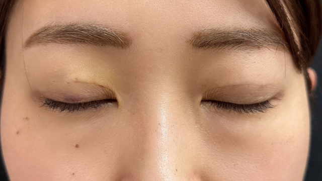 Postoperative Condition Part 1