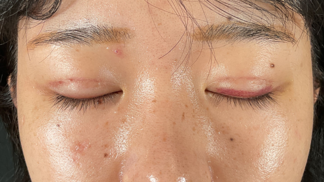 Postoperative Condition Part 1