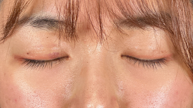 Postoperative Condition Part 1