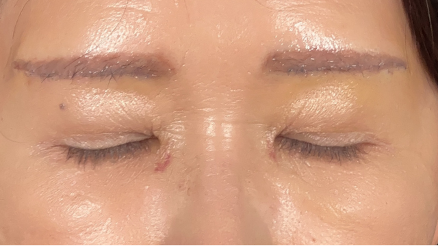 Postoperative Condition Part 1