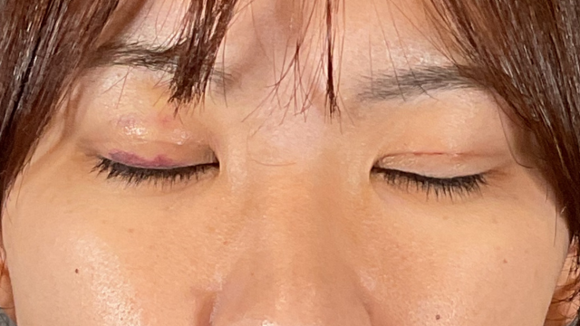 Postoperative Condition Part 1