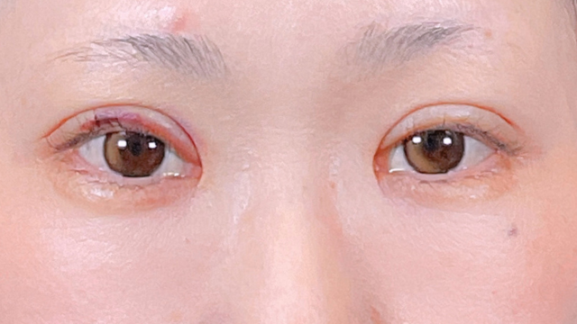 Postoperative Condition Part 1