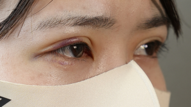 Postoperative Condition Part 1