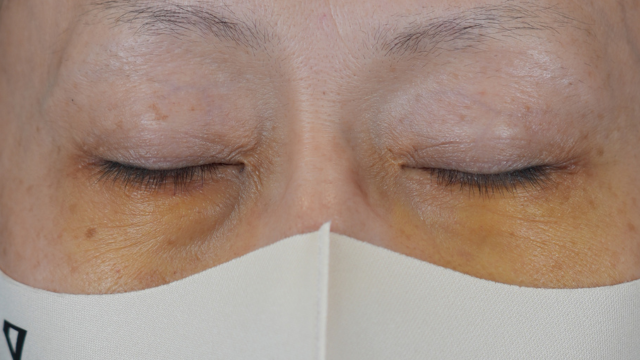 Postoperative Condition Part 1